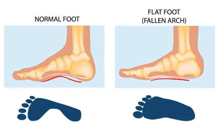  Understanding Flat Feet Problems: Causes, Symptoms, and Solutions Blog